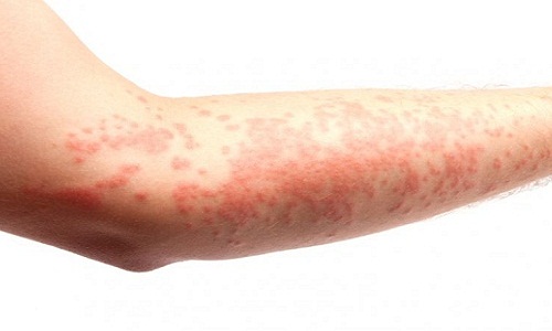 Eczema là bệnh gì và cách trị bệnh hiệu quả nhất hiện nay