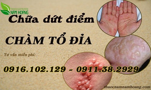 Mách bạn thuốc chữa eczema giúp bệnh khỏi tận gốc 100%