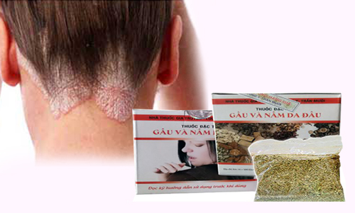 Thuốc đặc trị nấm da đầu Trần Mười