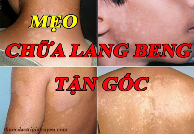 Bật mí cách chữa lang beng hiệu quả nhất hiện nay