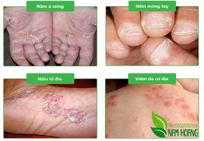 Bật mí cách trị bệnh nấm da hiệu quả nhanh nhất bạn nên biết