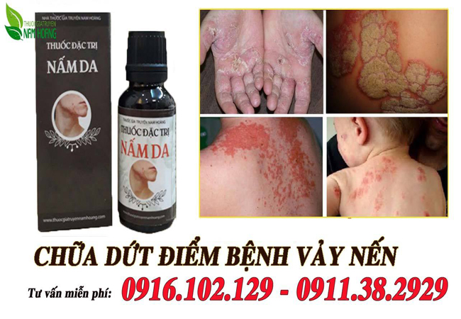 Da vảy nến và cách chữa hiệu quả mà lại rất rẻ bạn nên biết