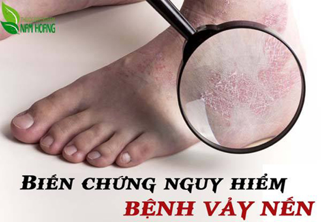 Da vảy nến và cách chữa hiệu quả mà lại rất rẻ bạn nên biết