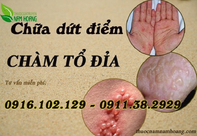 Mách bạn thuốc chữa eczema giúp bệnh khỏi tận gốc 100%