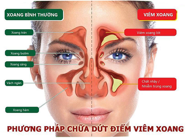 thuoc dac tri viem xoang tran muoi