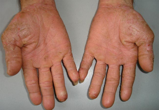 Thuốc trị nấm da tay bằng thảo dược giúp khỏi bệnh tận gốc